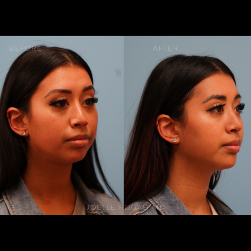 Nonsurgical Jawline Contouring
