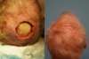 Scalp reconstruction after skin cancer surgery