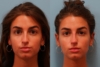 Nonsurgical Rhinoplasty