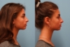Nonsurgical Rhinoplasty