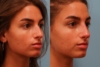 Nonsurgical Rhinoplasty