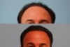 Hair Transplant