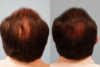 Hair Transplant