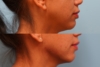 Jawline Fillers-2