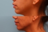 Jawline Filler