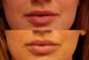 Lip Filler 2