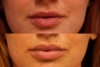 lip filler 2