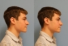 Nonsurgical Rhinoplasty